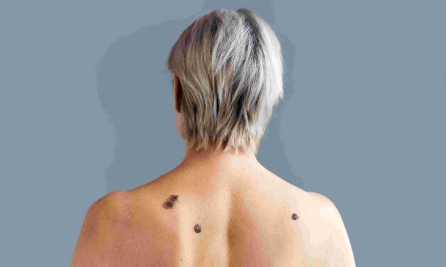 Clínica Piedra Azul realizará jornada gratuita de despistaje de melanoma