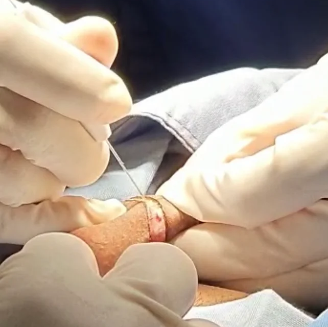 Circuncisión evita afecciones de salud por falta de higiene