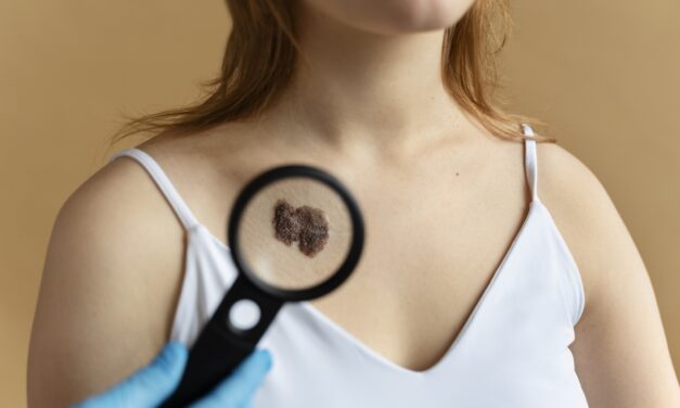 Lunares irregulares podrían ser alertas de cáncer de piel tipo melanoma