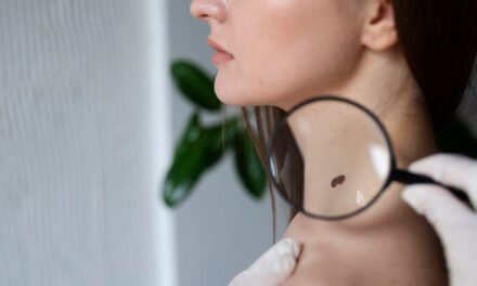 Melanoma se produce en más del 90% de los casos por falta de protección a rayos UV