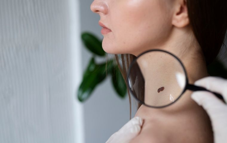 Melanoma se produce en más del 90% de los casos por falta de protección a rayos UV