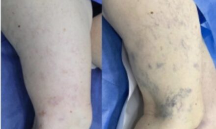 Flebofotorejuvenecimiento: Tecnología láser para tratar lesiones vasculares