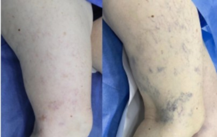 Flebofotorejuvenecimiento: Tecnología láser para tratar lesiones vasculares