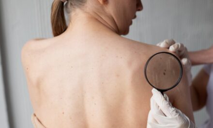 SAV realizó jornada de pesquisa de cáncer de piel