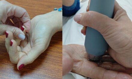 Ondas BTL tratan el dedo en gatillo sin necesidad de cirugía  