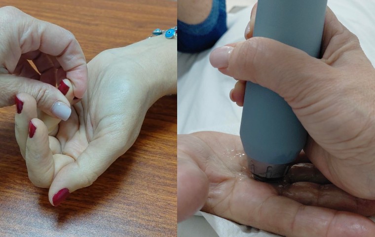 Ondas BTL tratan el dedo en gatillo sin necesidad de cirugía  