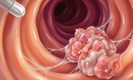 Aumento de cáncer colorrectal en jóvenes preocupa a la comunidad médica